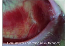 Conjunctival Laceration